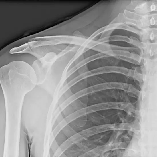 X-ray Right Shoulder Joint AP/Lateral